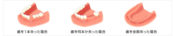 歯を1本失った場合、歯を何本か失った場合、歯を全部失った場合